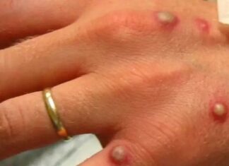 OMS em alerta: Surto de Mpox na África levanta preocupações