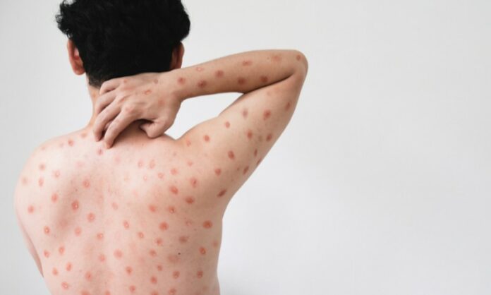 Entenda-nova-variante-de-mpox-que-pode-comprometer0019601500202408201442
