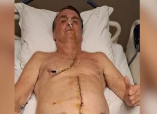 Bolsonaro posta foto do intestino exposto após complicação da facada