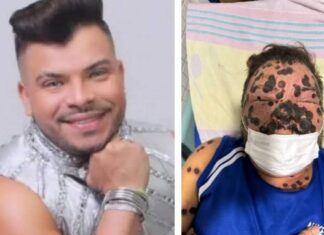 Cantor paraense morre vítima de Mpox (monkeypox) após contrair doença na Bahia