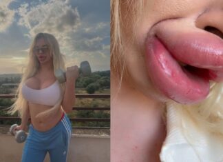 Preenchimentos labiais deixam influencer com dificuldade para fechar a boca e respirar