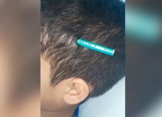 Criança de 9 anos sofre agressão de colega e tem lápis fincado na cabeça