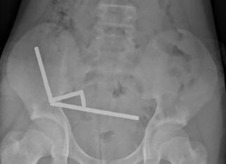 Menino de 13 anos perde parte do intestino após ingerir ímãs magnéticos