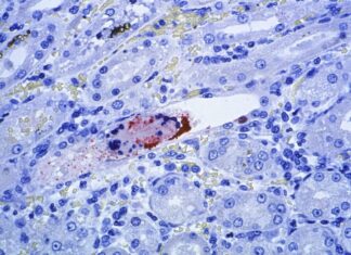 Nipah: vírus sem vacina e com alta letalidade acende alerta sanitário na Ásia