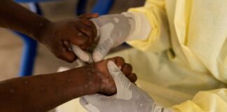 Brasil registra 88 casos de Mpox em 2026; São Paulo lidera com 62 confirmações