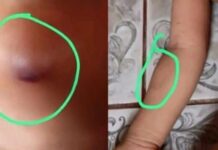 Criança de 3 anos volta de creche indígena com mordidas no rosto e no braço