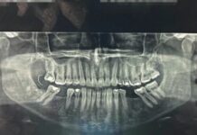 Agulha fica alojada na gengiva e é encontrada 10 dias após procedimento dentário
