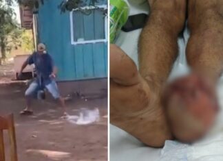 Explosão de ‘catolé’ deixa homem gravemente ferido durante brincadeira