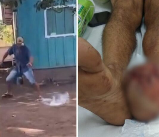 Explosão de ‘catolé’ deixa homem gravemente ferido durante brincadeira