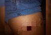 Mulher é atingida de raspão por tir0 após Festival de Verão em Maués